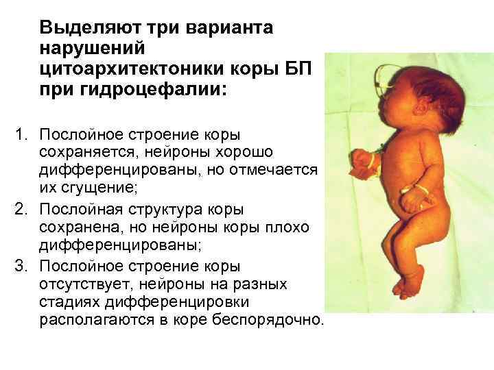 Выделяют три варианта нарушений цитоархитектоники коры БП при гидроцефалии: 1. Послойное строение коры сохраняется,