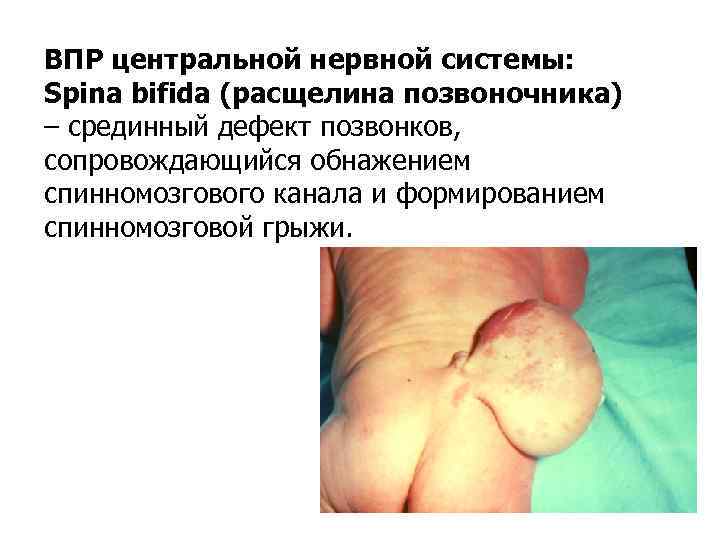 ВПР центральной нервной системы: Spina bifida (расщелина позвоночника) – срединный дефект позвонков, сопровождающийся обнажением