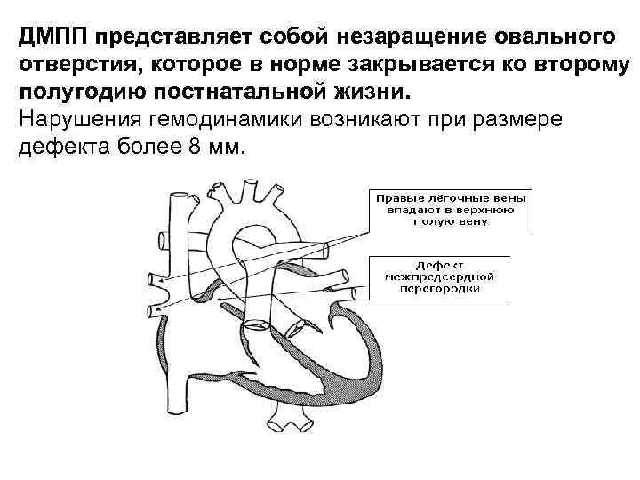 Для аускультативной картины дмпп характерно