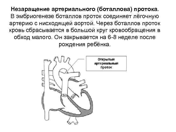 Схема открытого артериального протока