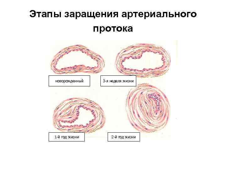 Этапы заращения артериального протока новорожденный 1 -й год жизни 3 -я неделя жизни 2