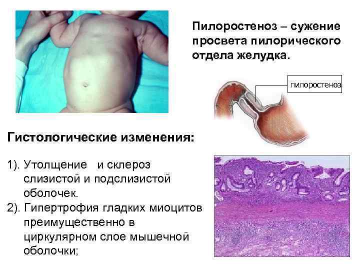 Эритематозная гастропатия на фоне атрофии слизистой антрального отдела желудка