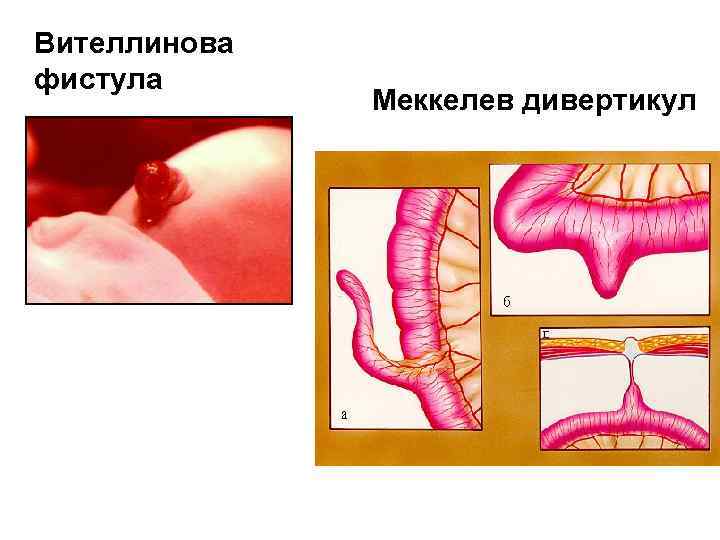 Вителлинова фистула Меккелев дивертикул 