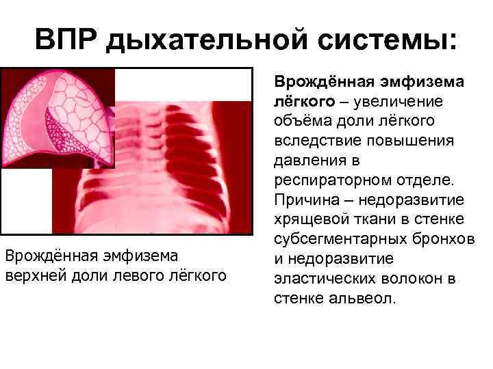 Врожденная лобарная эмфизема у детей презентация