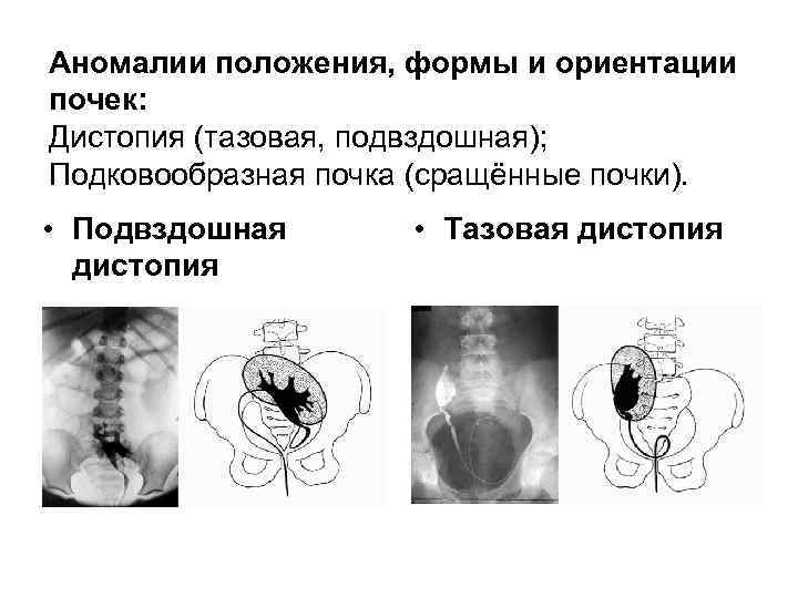 Дистопия почки. Подвздошная дистопия почки. Аномалии положени япрочек. Аномалии расположения почек дистопия. Дистопия почки классификация.