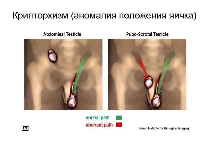 Крипторхизм (аномалия положения яичка) 