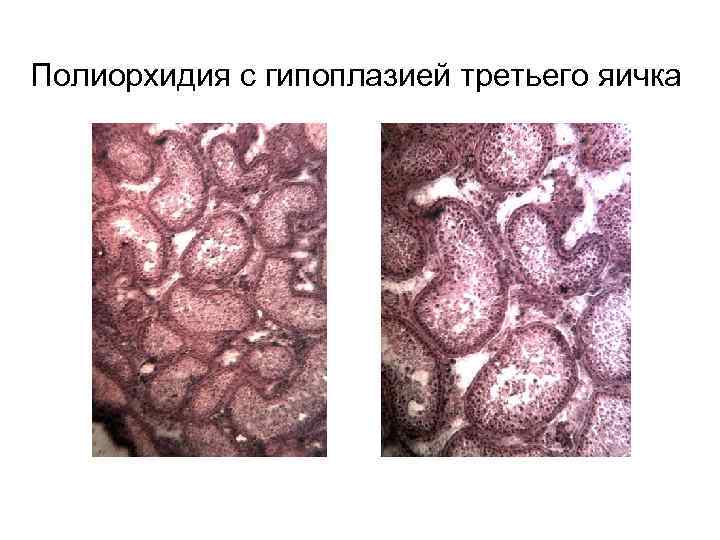 Полиорхидия с гипоплазией третьего яичка 