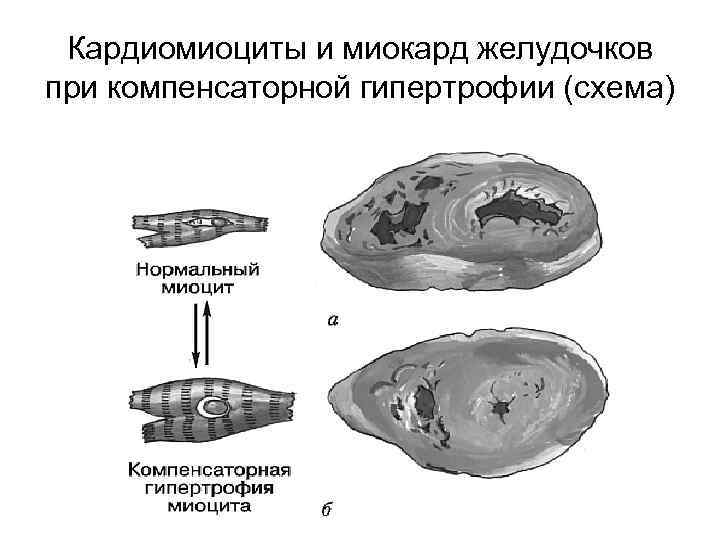 Кардиомиоциты и миокард желудочков при компенсаторной гипертрофии (схема) 