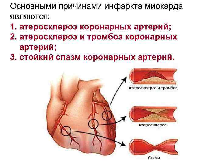 Основными причинами инфаркта миокарда являются: 1. атеросклероз коронарных артерий; 2. атеросклероз и тромбоз коронарных