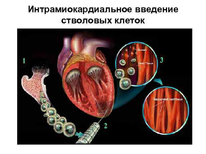 Интрамиокардиальное введение стволовых клеток 