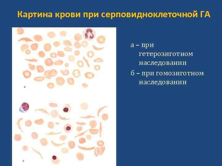 Картина крови при серповидноклеточной ГА а – при гетерозиготном наследовании б – при гомозиготном