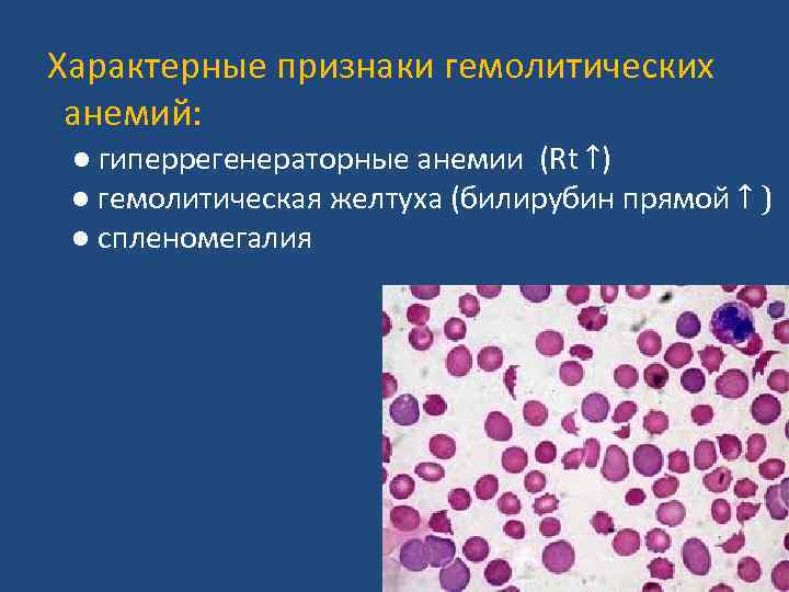Характерные признаки гемолитических анемий: ● гиперрегенераторные анемии (Rt ↑) ● гемолитическая желтуха (билирубин прямой