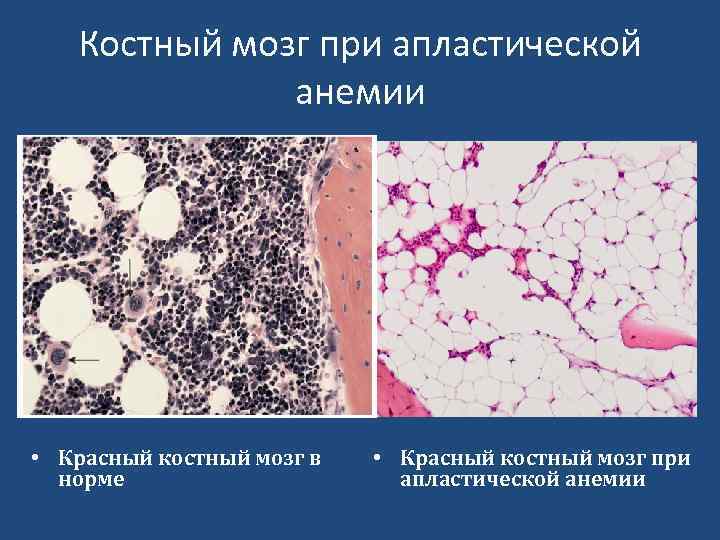 Костный мозг при апластической анемии • Красный костный мозг в норме • Красный костный