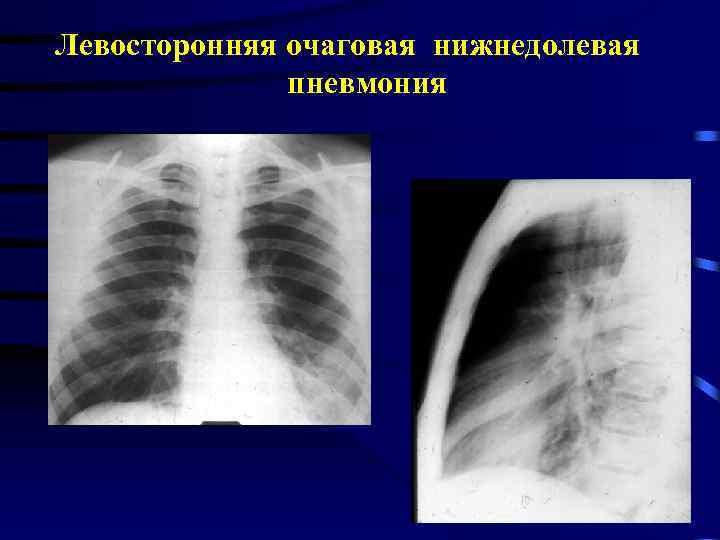 Левосторонняя очаговая нижнедолевая пневмония 