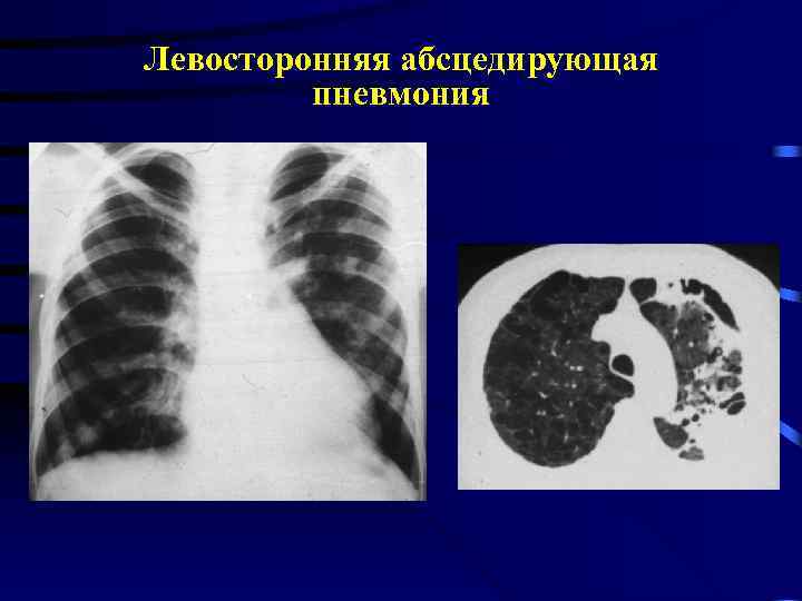 Левосторонняя абсцедирующая пневмония 