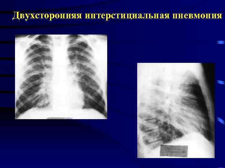 Двухсторонняя интерстициальная пневмония 