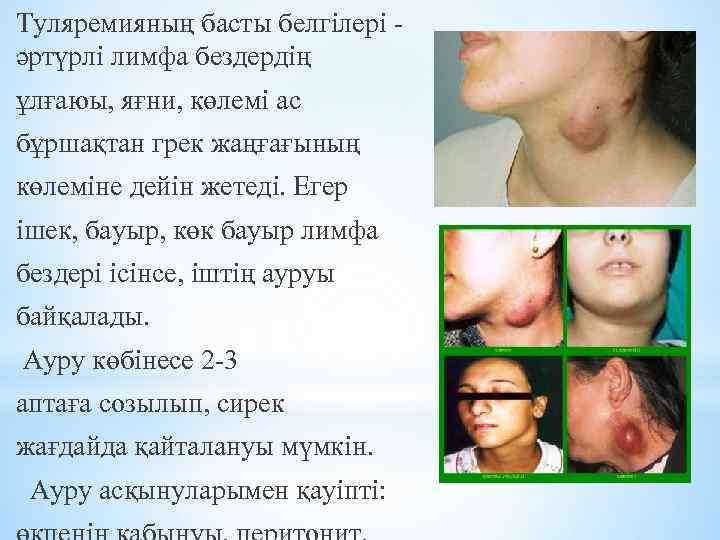 Туляремияның басты белгілері әртүрлі лимфа бездердің ұлғаюы, яғни, көлемі ас бұршақтан грек жаңғағының көлеміне
