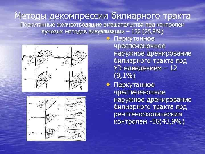 Методы декомпрессии билиарного тракта Перкутанные желчеотводящие вмешательства под контролем лучевых методов визуализации – 132