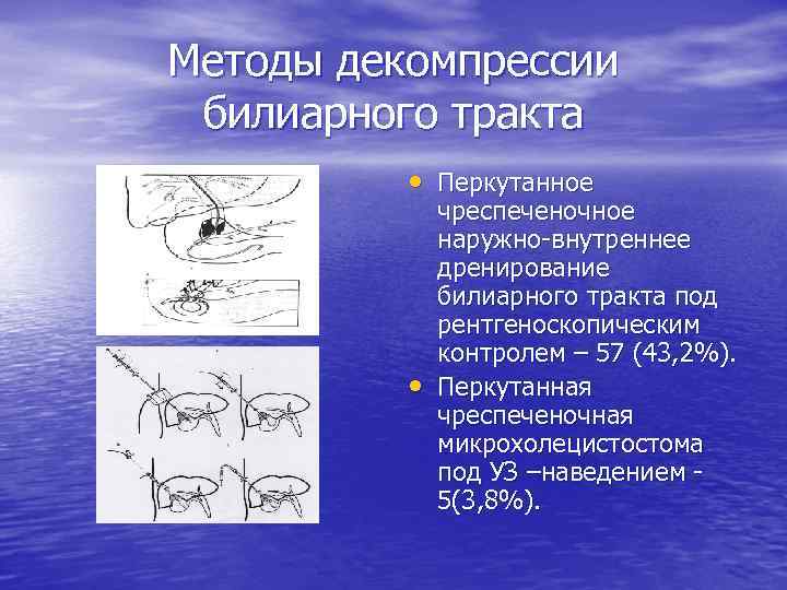 Методы декомпрессии билиарного тракта • Перкутанное • чреспеченочное наружно-внутреннее дренирование билиарного тракта под рентгеноскопическим