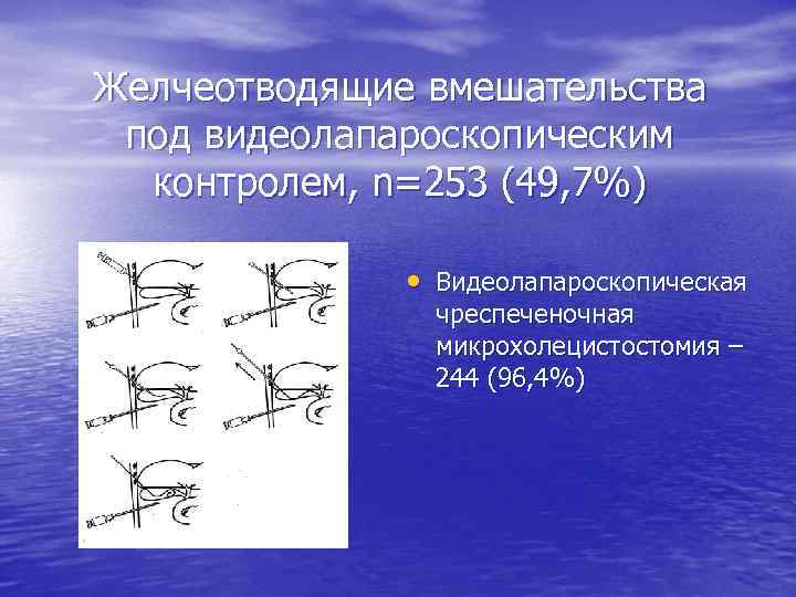 Желчеотводящие вмешательства под видеолапароскопическим контролем, n=253 (49, 7%) • Видеолапароскопическая чреспеченочная микрохолецистостомия – 244