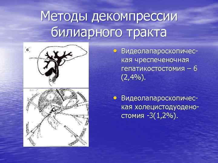 Методы декомпрессии билиарного тракта • Видеолапароскопическая чреспеченочная гепатикостостомия – 6 (2, 4%). • Видеолапароскопичес-