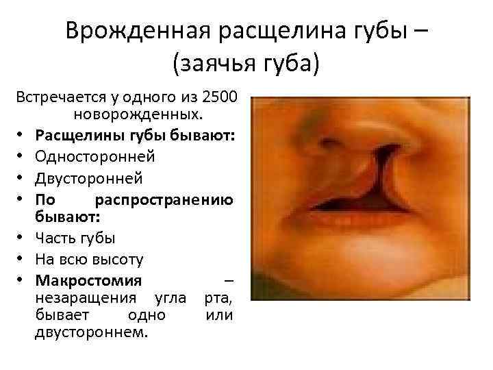 Врожденная расщелина губы – (заячья губа) Встречается у одного из 2500 новорожденных. • Расщелины