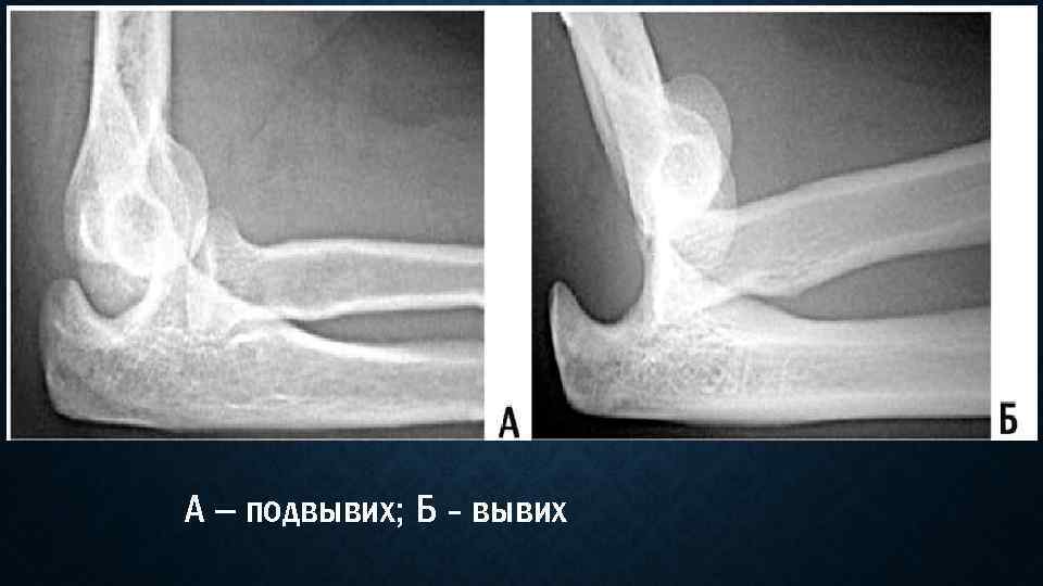 А – подвывих; Б - вывих 