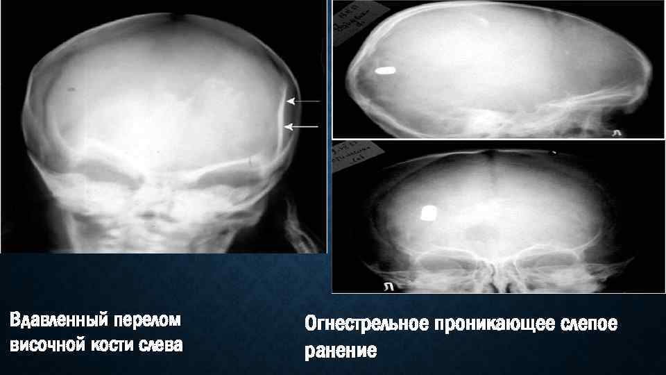 Вдавленный перелом височной кости слева Огнестрельное проникающее слепое ранение 