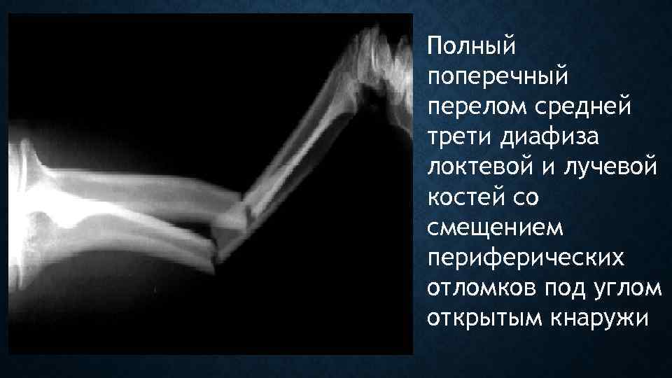 Полный поперечный перелом средней трети диафиза локтевой и лучевой костей со смещением периферических отломков