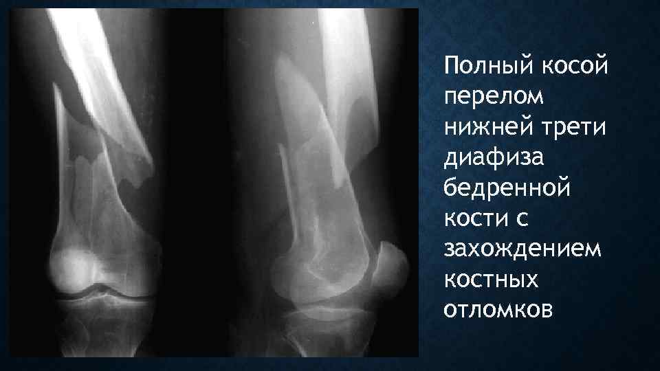 Полный косой перелом нижней трети диафиза бедренной кости с захождением костных отломков 