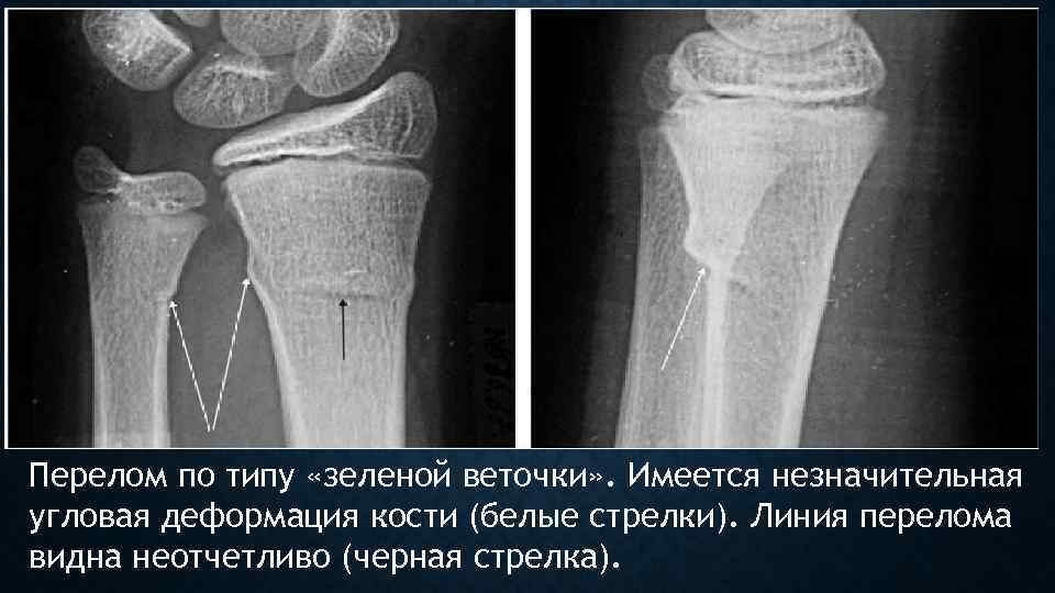 Перелом по типу «зеленой веточки» . Имеется незначительная угловая деформация кости (белые стрелки). Линия