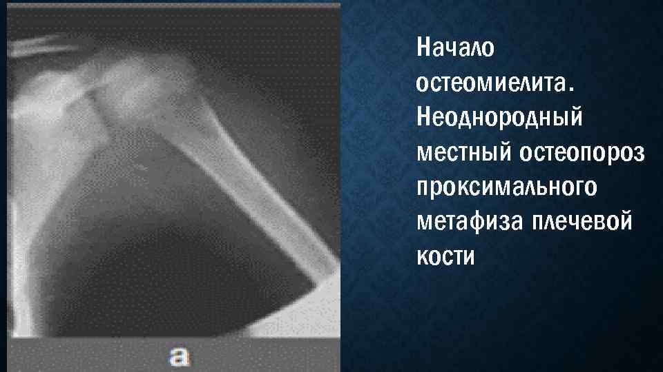 Начало остеомиелита. Неоднородный местный остеопороз проксимального метафиза плечевой кости 