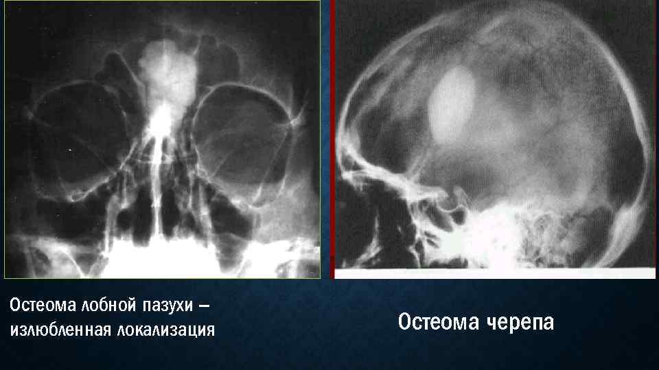 Остеома лобной пазухи – излюбленная локализация Остеома черепа 