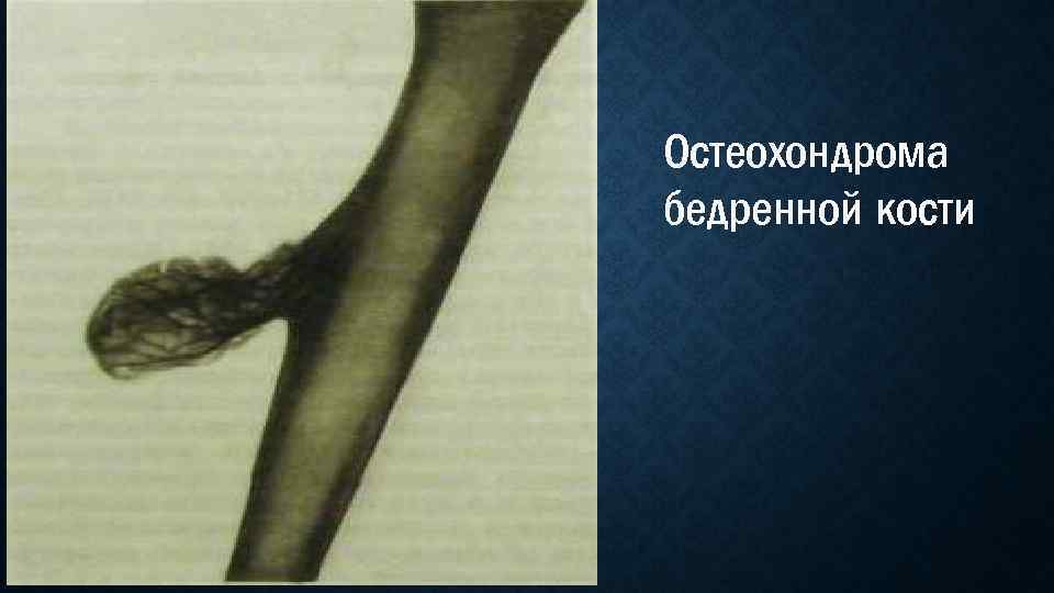 Остеохондрома бедренной кости 