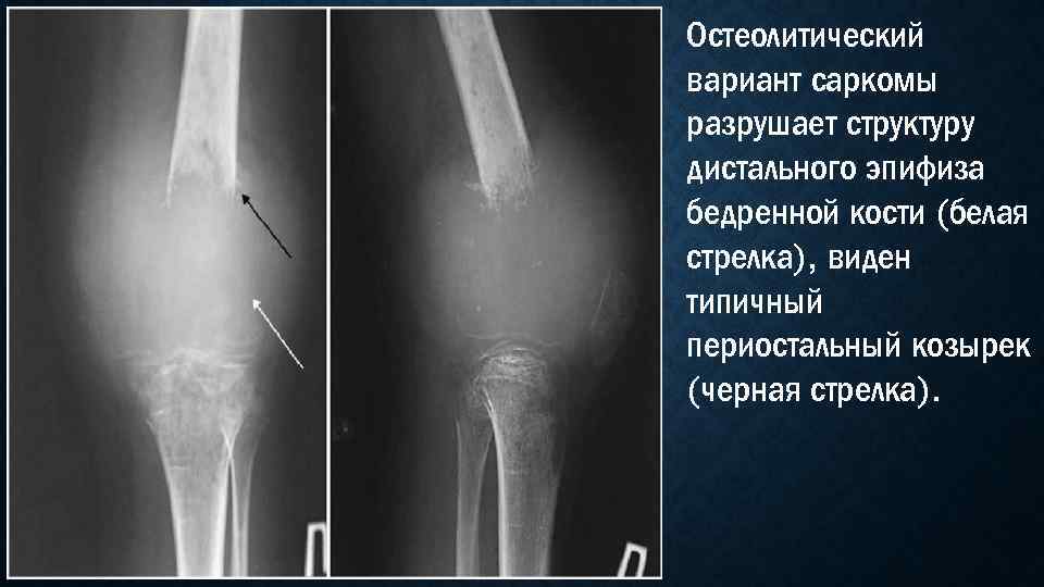 Остеолитический вариант саркомы разрушает структуру дистального эпифиза бедренной кости (белая стрелка), виден типичный периостальный