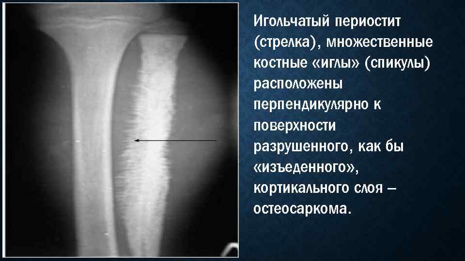 Игольчатый периостит (стрелка), множественные костные «иглы» (спикулы) расположены перпендикулярно к поверхности разрушенного, как бы