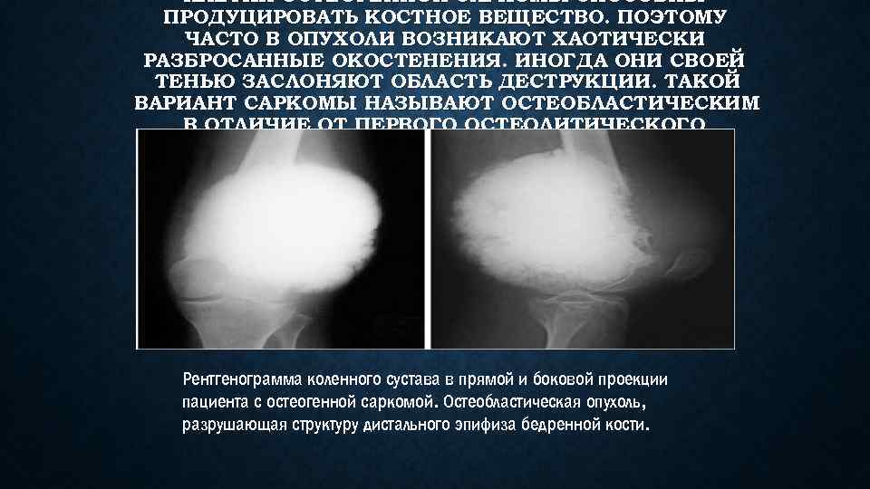 КЛЕТКИ ОСТЕОГЕННОЙ САРКОМЫ СПОСОБНЫ ПРОДУЦИРОВАТЬ КОСТНОЕ ВЕЩЕСТВО. ПОЭТОМУ ЧАСТО В ОПУХОЛИ ВОЗНИКАЮТ ХАОТИЧЕСКИ РАЗБРОСАННЫЕ