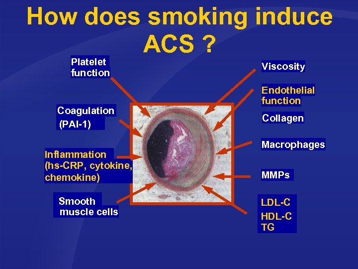 How does smoking induce ACS ? Platelet function Coagulation (PAI-1) Inflammation (hs-CRP, cytokine, chemokine)