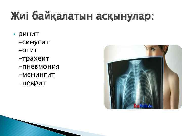 Жиі байқалатын асқынулар: ринит -синусит -отит -трахеит -пневмония -менингит -неврит 