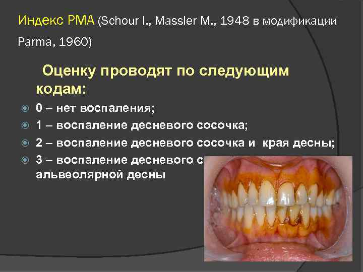 Индекс РМА (Schour I. , Massler M. , 1948 в модификации Parma, 1960) Оценку
