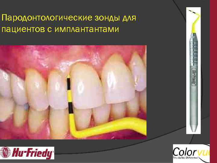 Пародонтологические зонды для пациентов с имплантантами 