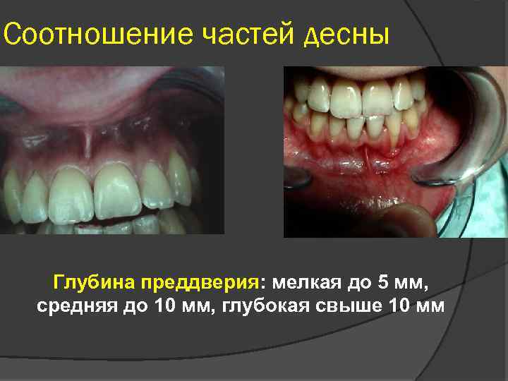 Соотношение частей десны Глубина преддверия: мелкая до 5 мм, средняя до 10 мм, глубокая
