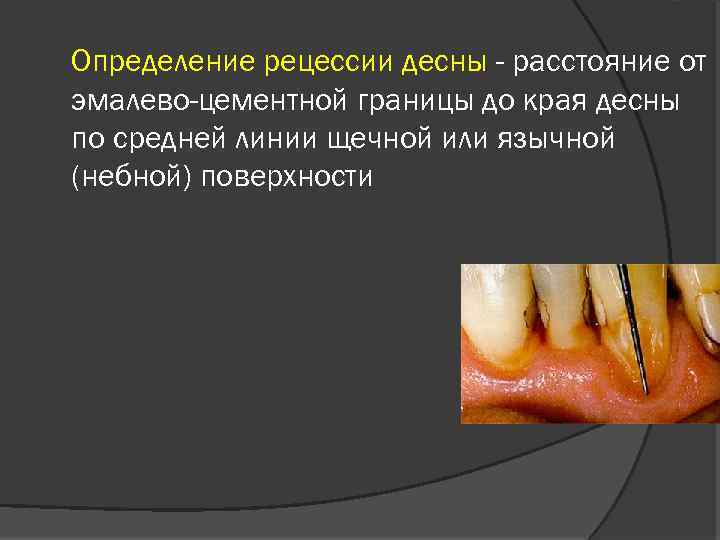 Определение рецессии десны - расстояние от эмалево-цементной границы до края десны по средней линии