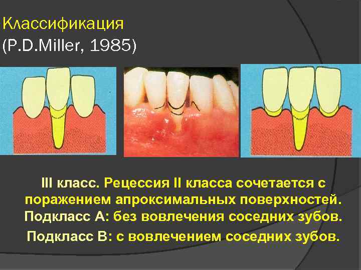 Методы обследования больных с заболеваниями пародонта презентация