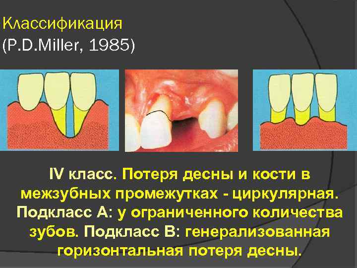 Классификация (P. D. Miller, 1985) IV класс. Потеря десны и кости в межзубных промежутках