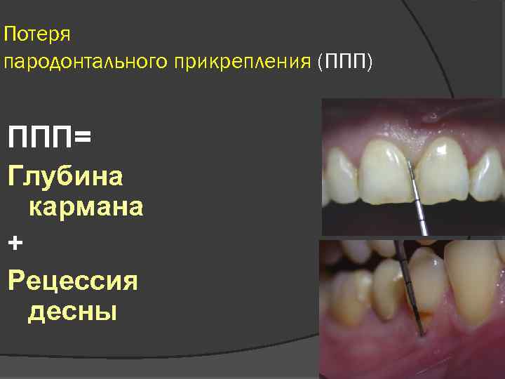 Потеря пародонтального прикрепления (ППП) ППП= Глубина кармана + Рецессия десны 