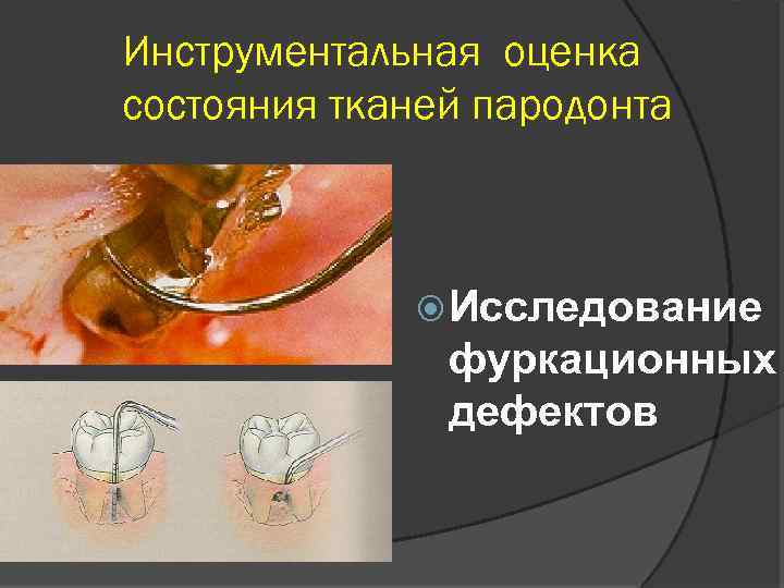 Инструментальная оценка состояния тканей пародонта Исследование фуркационных дефектов 