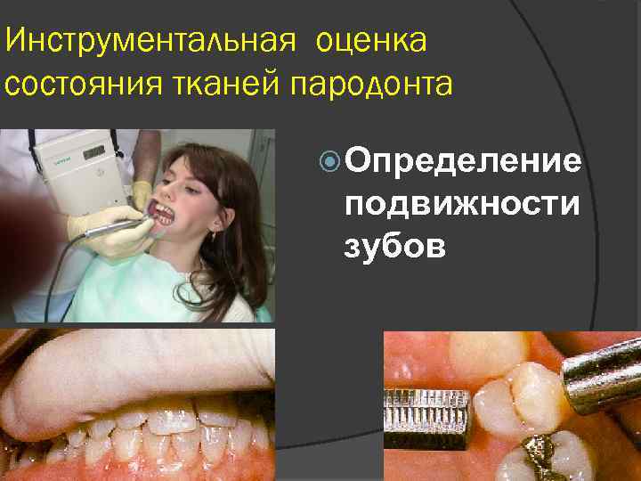 Инструментальная оценка состояния тканей пародонта Определение подвижности зубов 