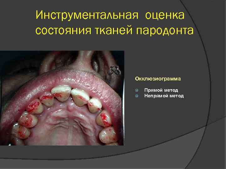 Инструментальная оценка состояния тканей пародонта Окклюзиограмма Прямой метод Непрямой метод 