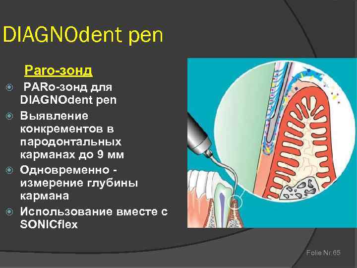 DIAGNOdent pen Paro-зонд PARо-зонд для DIAGNOdent pen Выявление конкрементов в пародонтальных карманах до 9